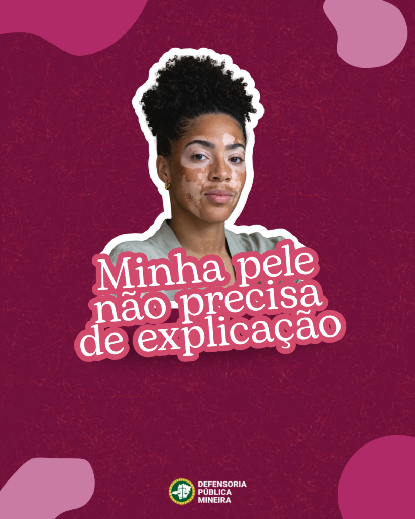 Vitiligo: minha pele não precisa de explicação